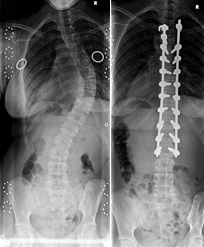 scoliosis-8c