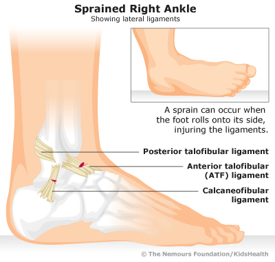 ankle foot sprains sprained right sprain if when happens ligaments kidshealth know clipart pain cliparts outer bruised illustration part injury