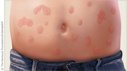 Diagnose My Skin Rash - Healthy Skin Care