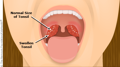 Treating swollen tonsils with steroids