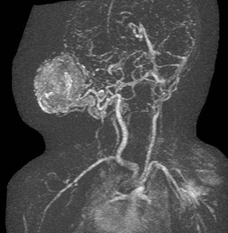 Diagnostic MRA of large hemangioma