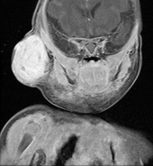 Diagnostic MRI (frontal) of large hemangioma