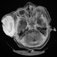Diagnostic MRI (transverse) of large hemangioma