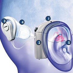 Cochlear Implant FAQ