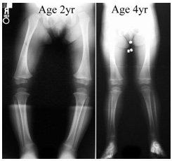 Knock Knees  Boston Children's Hospital