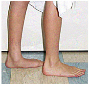 The doctor is concerned if the flatfoot is stiff, painful, or very severe.
