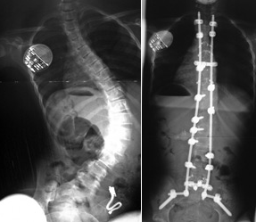 scoliosis-8a