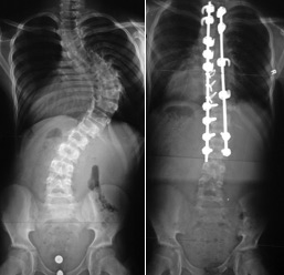 scoliosis-8b