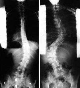 scoliosis_1_0001