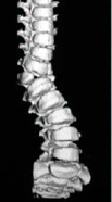 scoliosis_1_0002