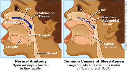 sleep apnea children obstructive snoring teens adenoids tonsils breathing causes child snore problems enlarged lungs affect their airway if obese