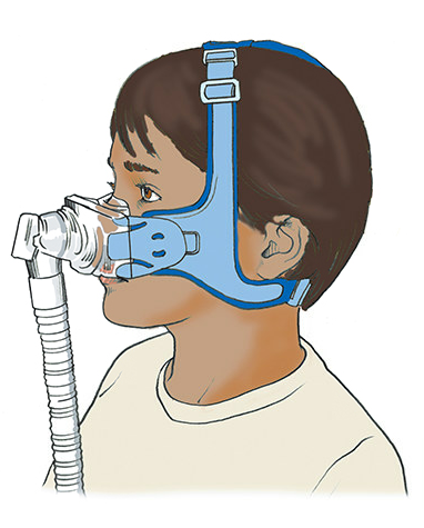 Child using a PAP mask for airway support during sleep.