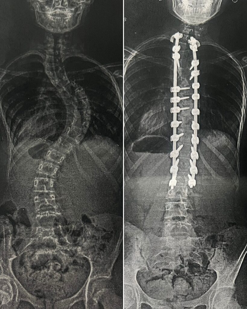 X-rays of Divya’s spine before and after spinal fusion surgery at Rady Children’s