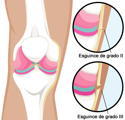 Lesiones Del Ligamento Lateral Interno Lli