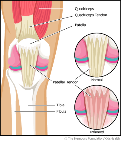 Jumper S Knee Patellar Tendonitis