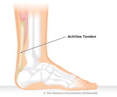 Achilles Tendonitis Tendons attach muscles to the bones, while ligaments attach bones to other bones. achilles tendonitis