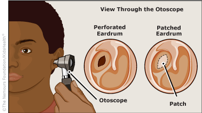 Perforated Eardrum