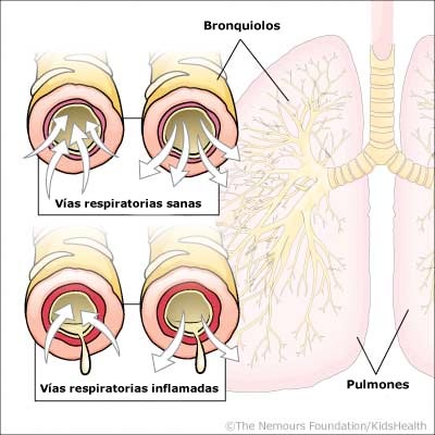 bronquiolitis
