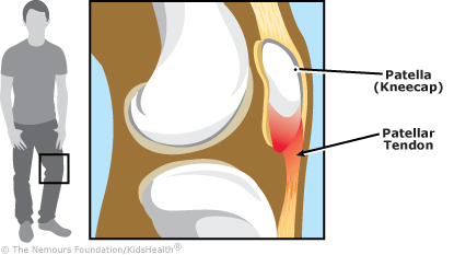Sinding Larsen Johansson Syndrome
