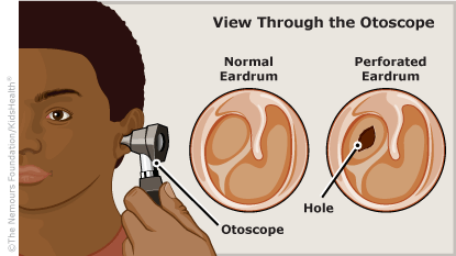 perforated eardrum