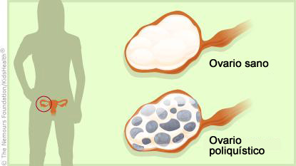 Sindrome De Ovario Poliquistico