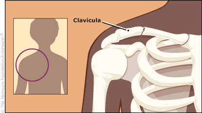 Fractura De Clavicula