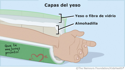 Yesos Y Férulas
