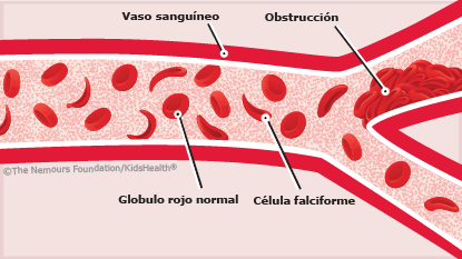 Resultado de imagen de anemia falciforme