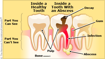 to reduce in fever kids how A to Periapical Z: Abscess, to reduce in fever kids how A to Periapical Z: Abscess,