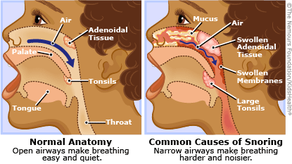 What causes people to snore