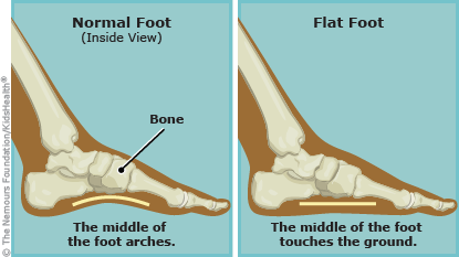 flat foot baby walking