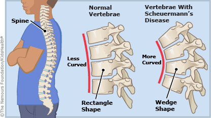 Kyphosis