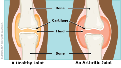 juvenile idiopathic arthritis juvenile rheumatoid arthritis symptom