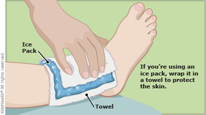 Ankle Sprains