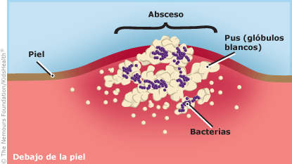 abscesos