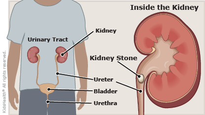 Kidney Stones