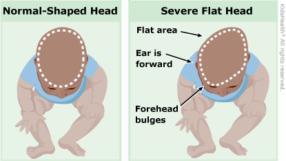Flat Head Syndrome Positional Plagiocephaly