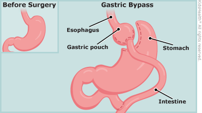bypass gastric surgery teen Hot cumshots big tits
