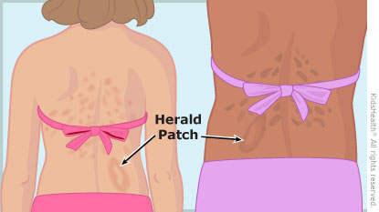Where can you find pictures of pityriasis rosea?
