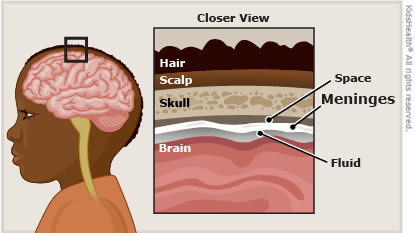 Meningitis Meningitis
