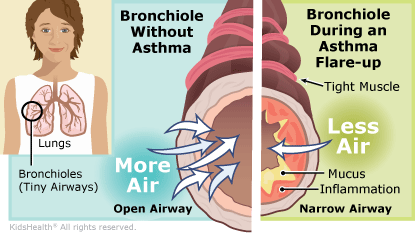 Dealing With An Asthma Flare Up Your asthma can flare up for different reasons. dealing with an asthma flare up